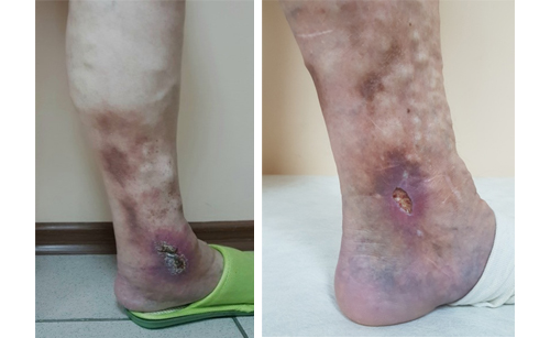 Фото ног пациенток с венозной экземой и индурацией кожи голени