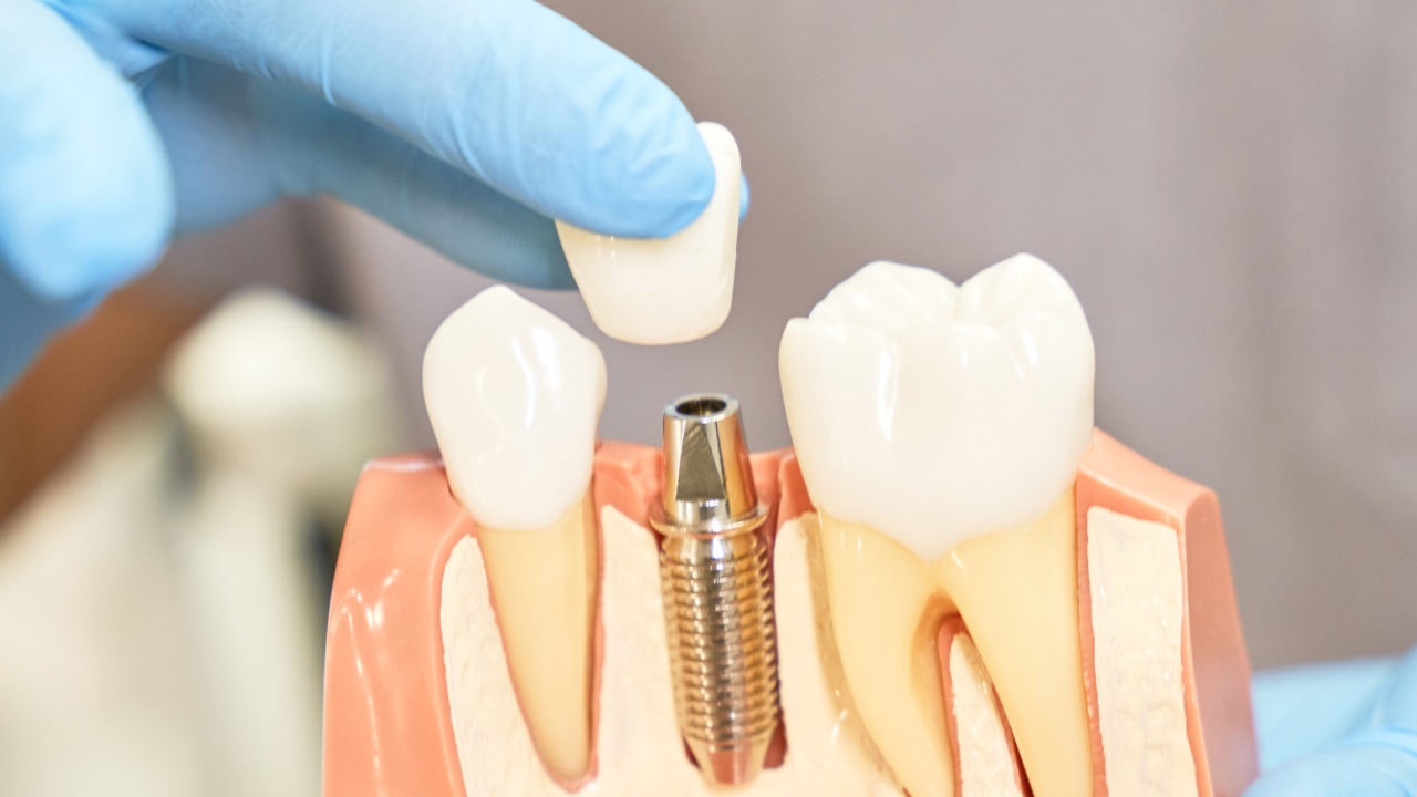 Восстановление зуба коронкой по акции (изготовление керамической коронки на каркасе из оксида циркония без нанесения) на имплантате